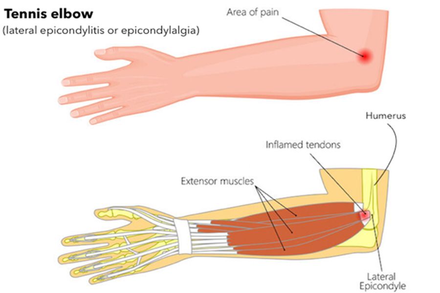 Tennis Elbow Symptoms Causes Treatment