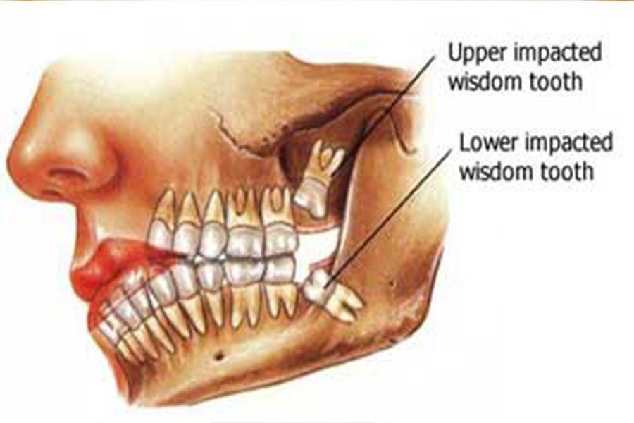 Wisdom Teeth Unfolding Facts and Myths