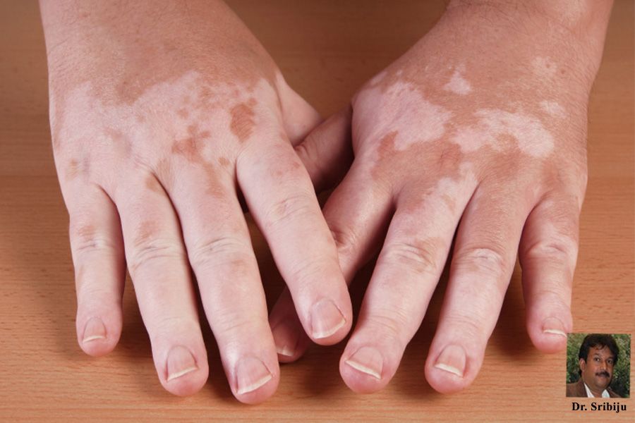 World Vitiligo Day Know the causes, symptoms and treatment by Dr. Sribiju