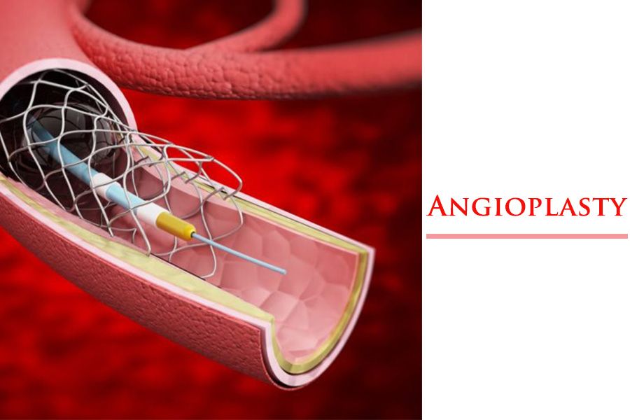 Understanding Angioplasty