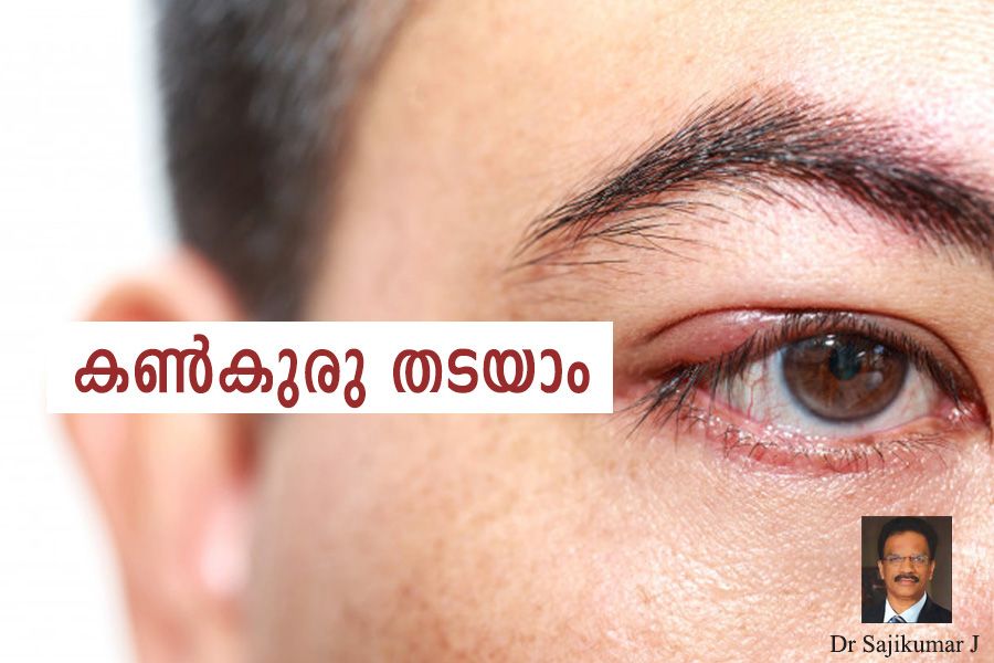 How to prevent eye infection article by Dr Sajikumar J